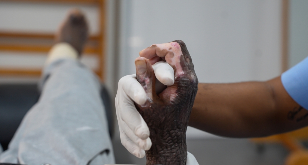 Kinesist helpt brandwondenpatiënt.